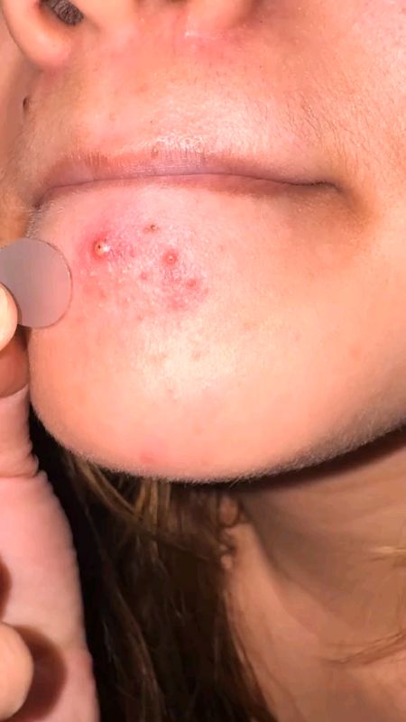 pimple patch#trending #fyp #sale #freecoinssashopeevedeo #shopeevedeo #MasMuraSaShopee #AngDaliDaliSaShopee #skincare
