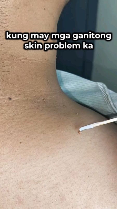 Kung may ganito karing skin problem subukan mo din ito  #kasoycream #skinproblem #warts #kulugo #skincare