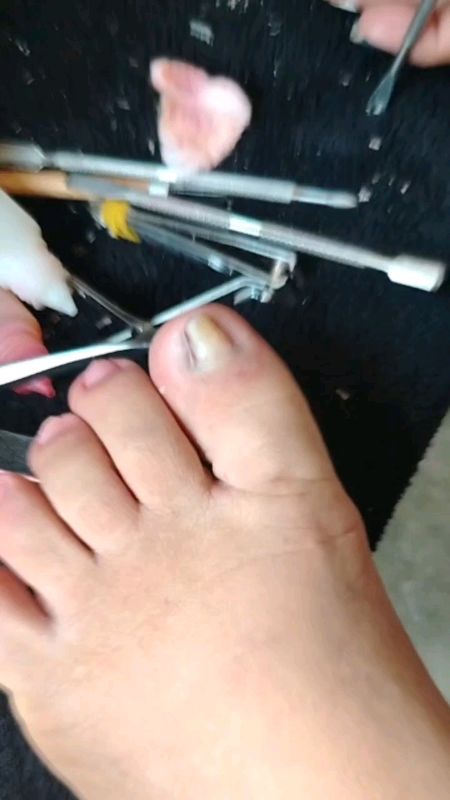 nakatusok na ingrown #ingrown #followers #everyone #higlights
