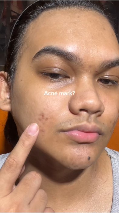 7-days spot journey 😍 #acne #acnefighter #acneproneskin #skincare #sensitiveskin #acnepowder #dralthea #calamine #spotpowder